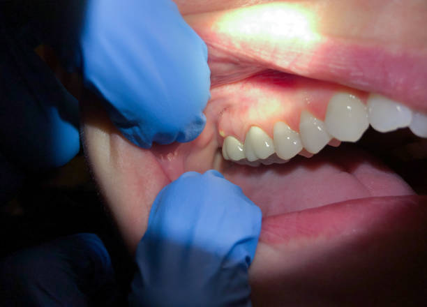 Best Emergency Dental Services for Seniors in Shinglehouse, PA